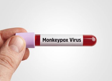 Maymun Çiçeği virüsü (MPXV) kavramı: Maymun Çiçeği virüsü taşıyan bilim adamı beyaz arka plandaki test tüpünde kanı enfekte etti.