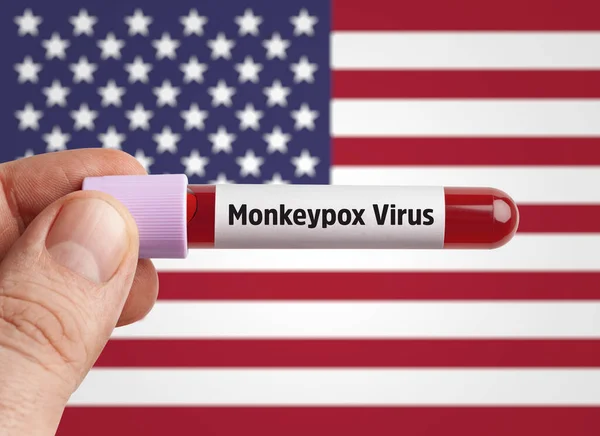 Concepto Del Virus Monkeypox Mpxv Científico Que Sostiene Sangre Infectada —  Fotos de Stock