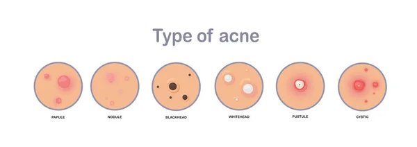 痤疮的概念 粉刺的类型 平面矢量图解 — 图库矢量图片