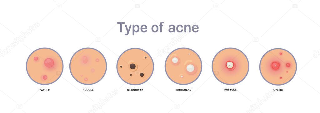 Acne concept. type of acne.papule,nodule,blackhead'whitehead,pustule,cystic.flat vector illustration.