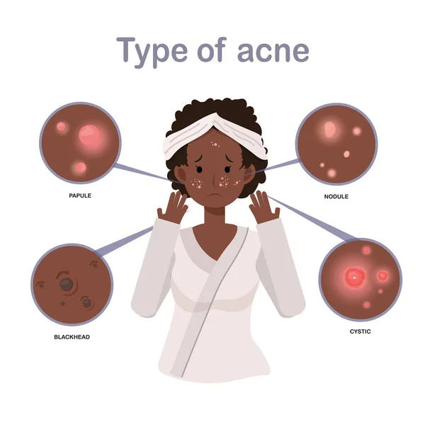 粉刺类型 面部粉刺 美容美发 化妆品 健康的非洲裔美国女人 平面矢量卡通人物插图 — 图库矢量图片