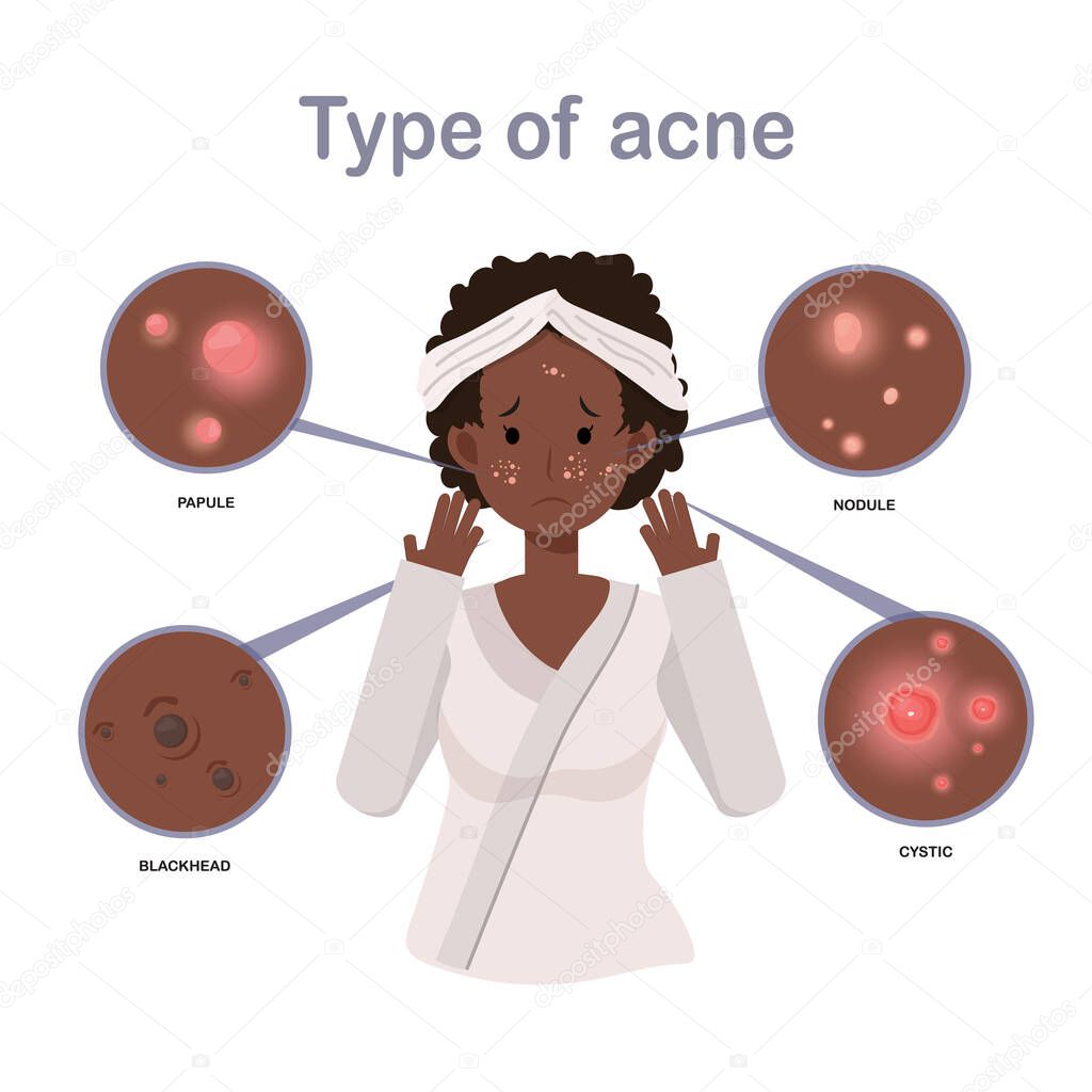 Acne Types.African american woman With Acne On Face, Facial, Beauty, Cosmetic, Makeup, Treatment, Healthy. Flat vector cartoon character illustration.