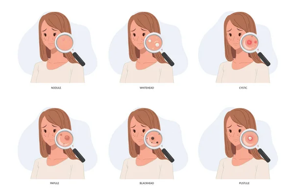 woman with magnifying glass close up type of acne.skin problem.skin care concept.acne problem. 