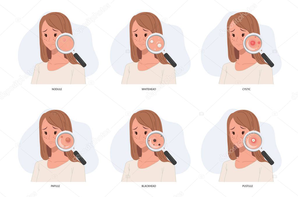 woman with magnifying glass close up type of acne.skin problem.skin care concept.acne problem. 