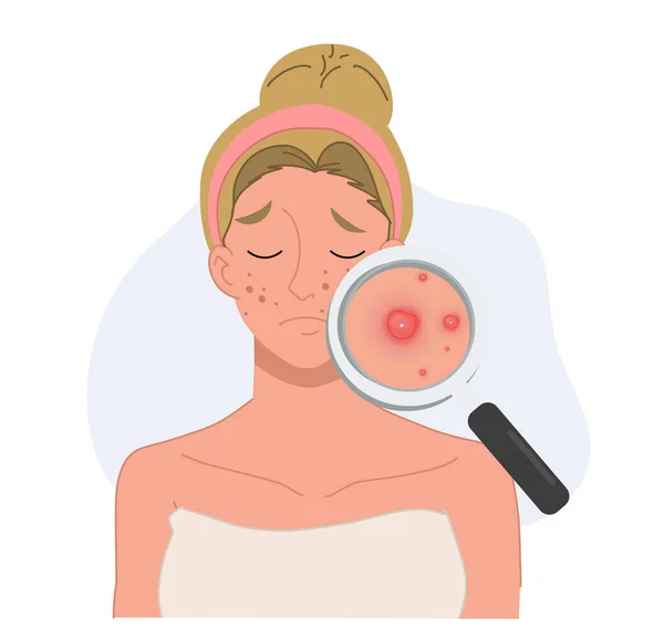 有关痤疮皮肤问题的病媒说明概念 戴放大镜的女人脸上有粉刺 — 图库矢量图片
