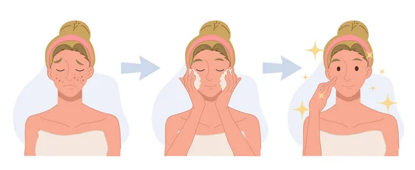 Treat Acne Skin Problem Pimple Woman Face Beautiful Step Cleansing — Stok Vektör