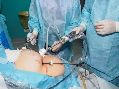 Ameliyat sırasında laparoskopik cerrahi manipülatörlü cerrahların elleri