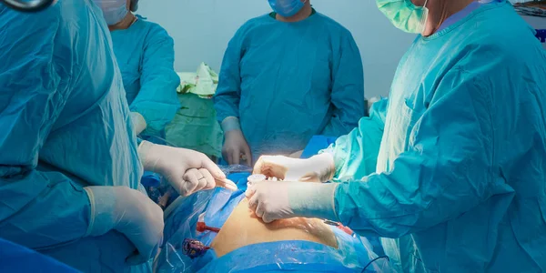Un grupo de cirujanos opera a un paciente en la mesa de operaciones. — Foto de Stock