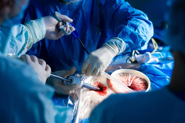 Chirurdzy pracują z manipulatorami laparoskopowymi używającymi trokarów — Zdjęcie stockowe