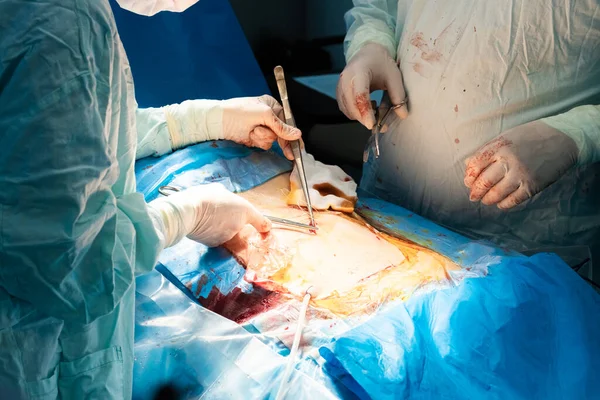 De chirurgen handen voeren een chirurgische operatie uit op het lichaam van de patiënt. — Stockfoto