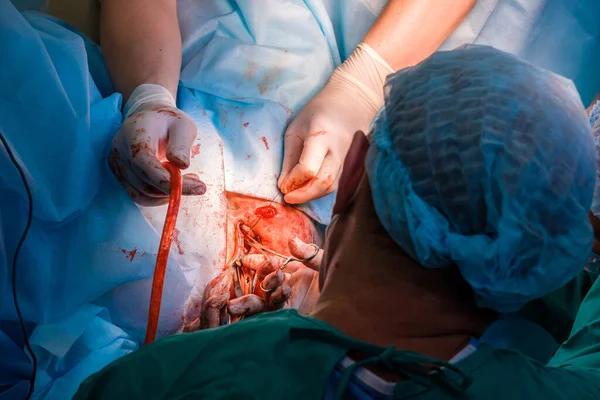 Chirurdzy używają narzędzi medycznych do zszywania ludzkiej skóry podczas operacji. — Zdjęcie stockowe