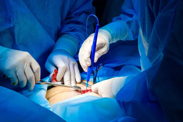 De chirurg houdt de elektrische coagulator vast tijdens de operatie. — Stockfoto