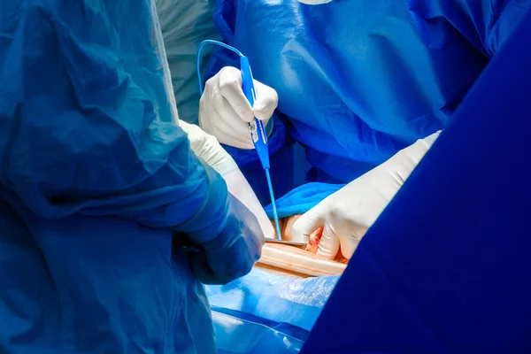 The hands of surgeons in sterile gloves operate with an electrocoagulator. — Stockfoto