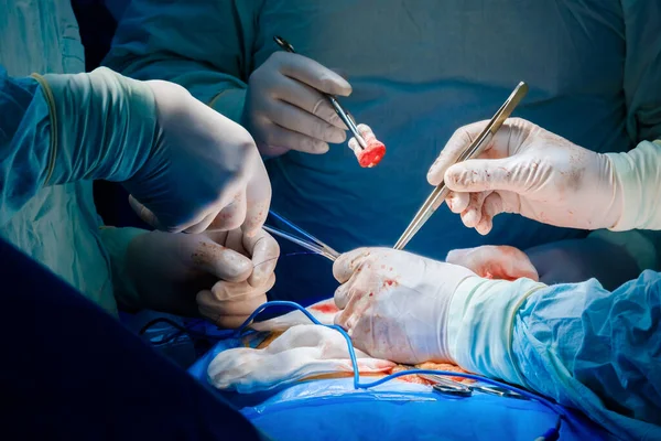 Chirurgische instrumenten in handen van artsen tijdens een chirurgische ingreep. — Stockfoto
