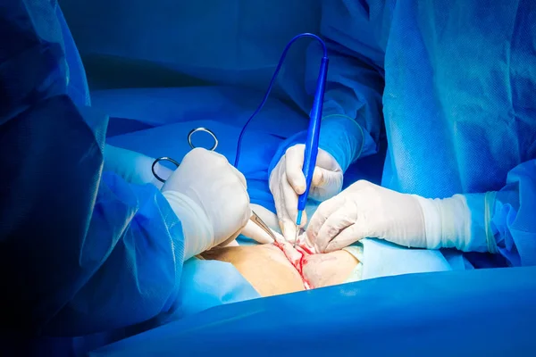 Las manos de los cirujanos con guantes estériles operan con un electrocoagulador. —  Fotos de Stock