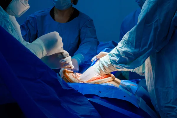 Surgery on the patients abdominal cavity. — Stock fotografie