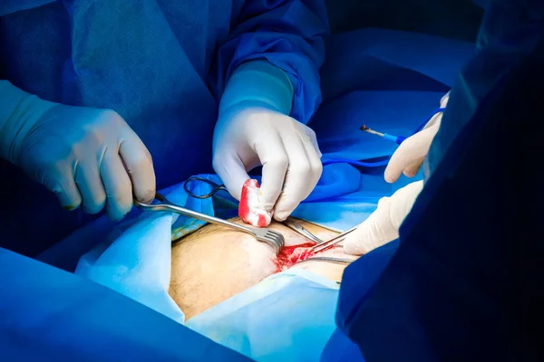 Dos pares de manos de cirujanos en xing operan en una persona. — Foto de Stock