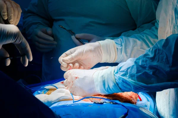 Stitching the patients skin at the end of the surgical operation. — Foto de Stock