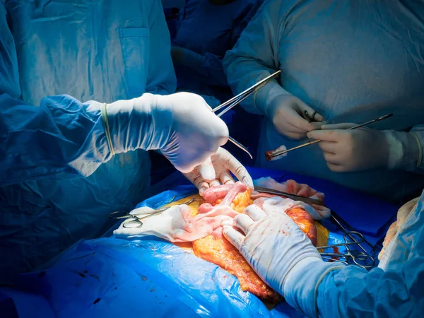 Mãos de cirurgiões durante a cirurgia na cavidade abdominal de uma pessoa. — Fotografia de Stock