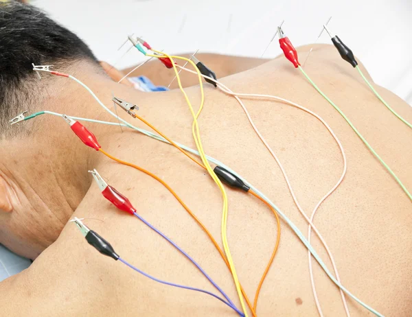 Leczenie akupunktura — Zdjęcie stockowe