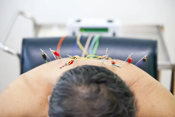 Acupuncture treatment — Stock Photo, Image