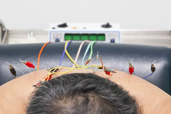 Traitement d'acupuncture — Photo