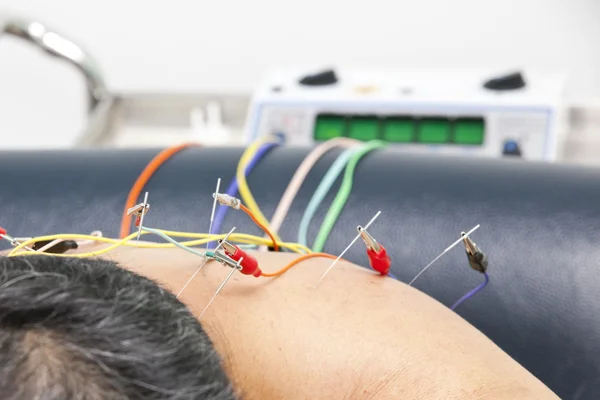 Tratamento da acupuntura — Fotografia de Stock