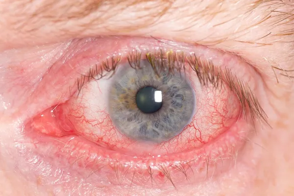 Olho humano vermelho — Fotografia de Stock