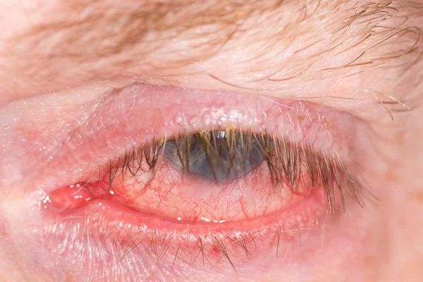 Fatigué oeil humain rouge — Photo
