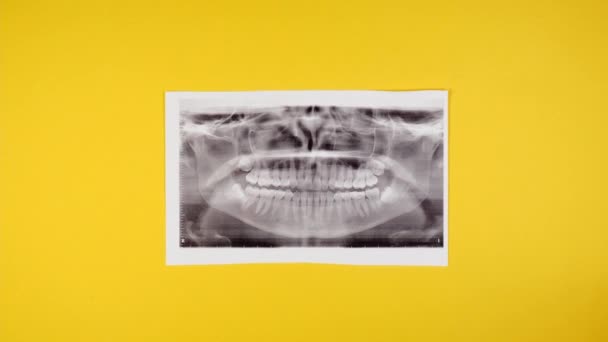 Close Shot Ray Straight Teeth Young Woman Wearing Braces Yellow — Stock Video
