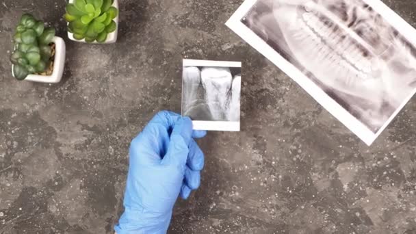 一名戴蓝色橡胶手套的矫正牙女医生的手拿着一副X光照片 照片上的牙齿是灰色背景的 戴上牙套后还带着一副X光的人类下巴 — 图库视频影像