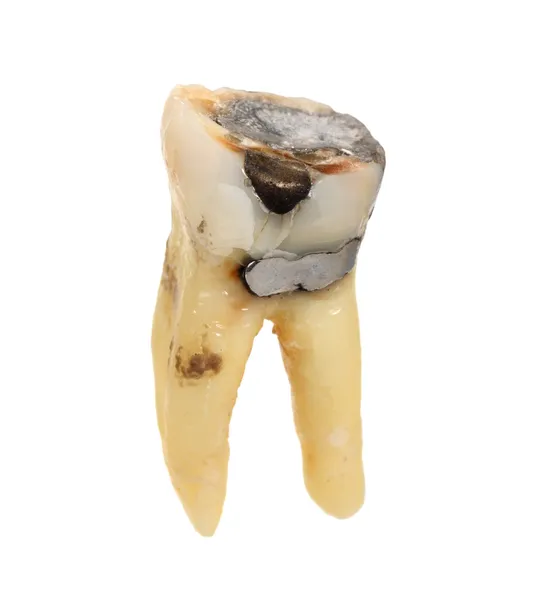 Tooth — Stock Photo, Image