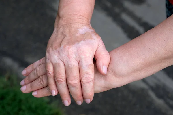 Mãos Femininas Com Vitiligo Close Mãos Mulher Dobraram Cima Outro — Fotografia de Stock