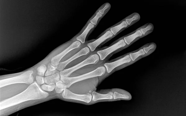 Xray Human Hand Fingers Top View 男性手和手腕的X光照片 手部整块健康骨骼的X光检查 — 图库照片