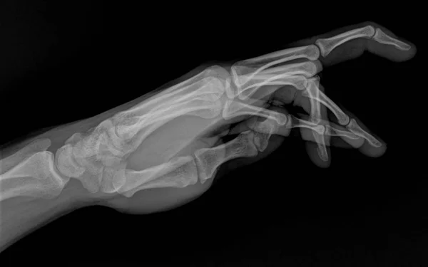 Xray Bent Human Hand Fingers Side View Ray Male Hand Imagem De Stock