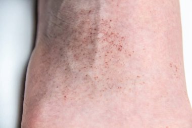 A red rash on the foot of a male against background. CloseUp a part of the leg with red allergic rash. Skin with allergy