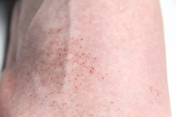A red rash on the foot of a male against background. CloseUp a part of the leg with red allergic rash. Skin with allergy