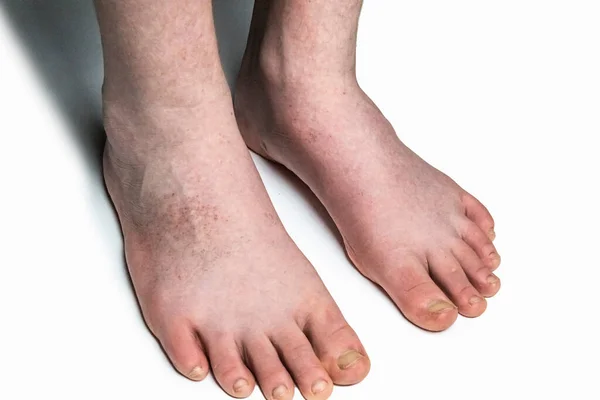 Skin with allergy,  food allergy, dermatitis, insect bites, irritation concept. A red rash on the feet of a male against  white background.