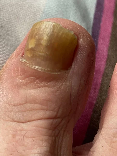 爪真菌 爪の黄色と肥厚を引き起こす真菌感染症であるOnychomosisに苦しんでいる人の大きなつま先 — ストック写真