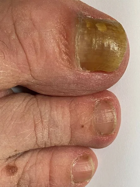 爪真菌 爪の黄色と肥厚を引き起こす真菌感染症であるOnychomosisに苦しんでいる人の大きなつま先 — ストック写真