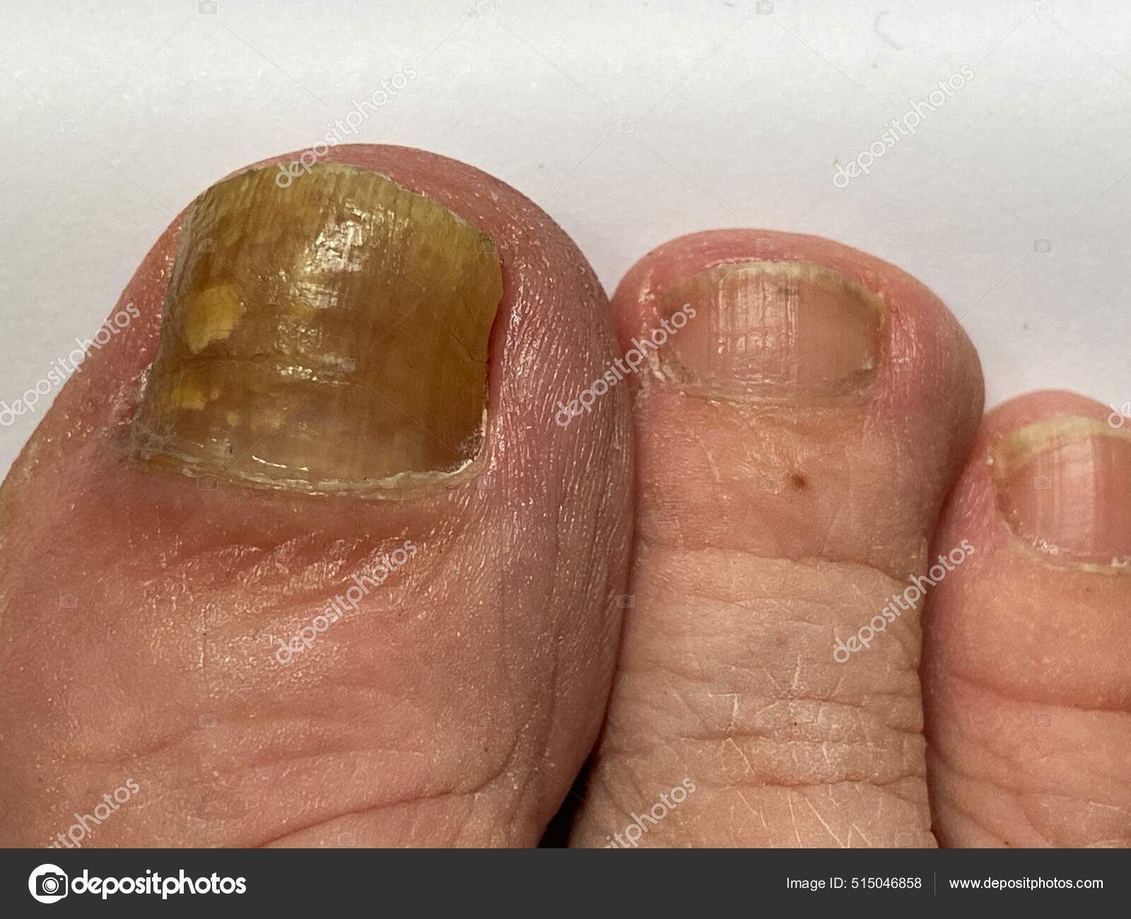 Toenail Nail Fungus Big Toe Person Suffering Onychomycosis Fungal