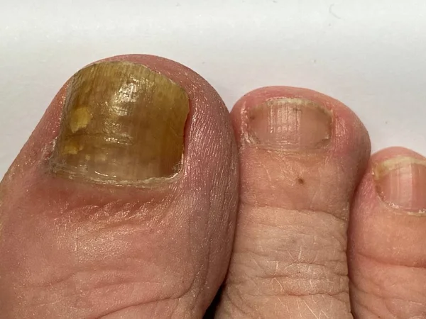 脚趾甲真菌病 Toenail Nail Fungus 一个人的大脚趾 感染了一种导致脚趾甲变黄和变厚的真菌感染 — 图库照片