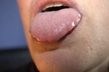 Dalgalı dalgalı deniz tarağı kenarlı şişmiş beyaz dil (tıbbi adı makroglossia) ve yalan tümsekleri