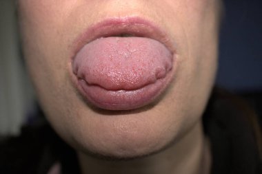 swollen enlarged white tongue with wavy ripple scalloped edges (medical name is macroglossia) and lie bumps clipart