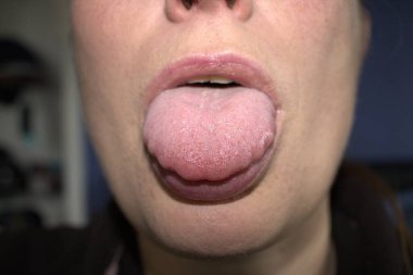 swollen enlarged white tongue with wavy ripple scalloped edges (medical name is macroglossia) and lie bumps clipart