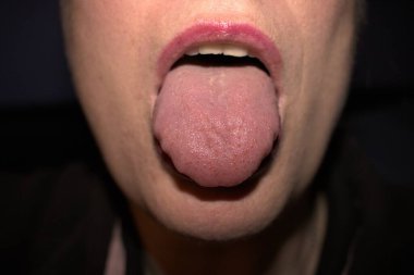 swollen enlarged white tongue with wavy ripple scalloped edges (medical name is macroglossia) and lie bumps clipart