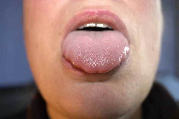 肿大的大的白色舌头 有波浪形的波纹鳞状边缘 医学名称为巨乳 并有肿块 — 图库照片