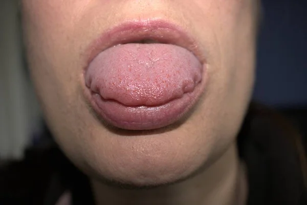 波打つリップルホタテの縁 医療名はマクログロシア と横の隆起を持つ腫れた白い舌 — ストック写真