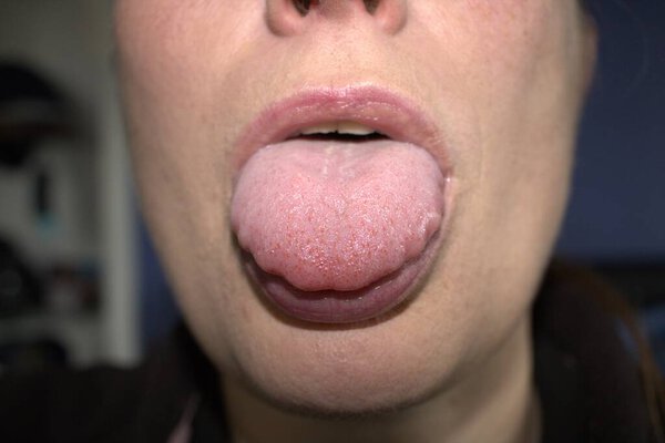 swollen enlarged white tongue with wavy ripple scalloped edges (medical name is macroglossia) and lie bumps