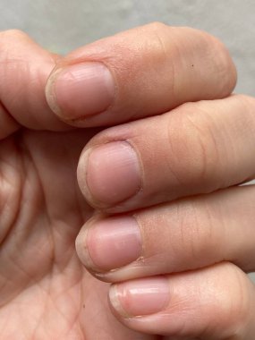 unusual shrunken missing lunula half moon on nails which is symptom of anaemia, malnutrition, kidney disease or other. with unhealthy proximal fold ,cuticle  clipart